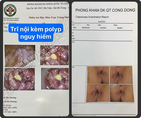 Cắt Trĩ Bằng Sóng Cao Tần HCPT II – Giải Pháp Cho Người Ngại Dao Kéo