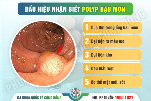 Biểu hiện của polyp hậu môn là gì? Cảnh báo dấu hiệu bất thường từ cơ thể bạn