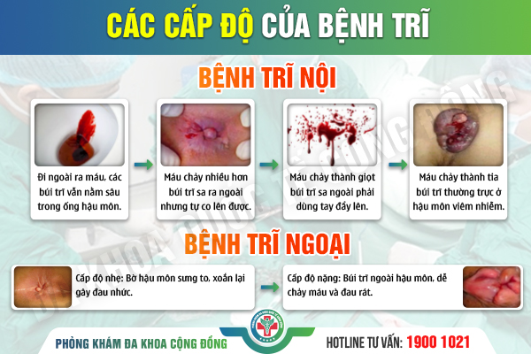 Mách bạn cách phân biệt trĩ nội và trĩ ngoại đơn giản