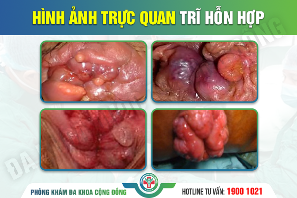 Biểu hiện bệnh trĩ hỗn hợp – Thông tin bạn nên biết