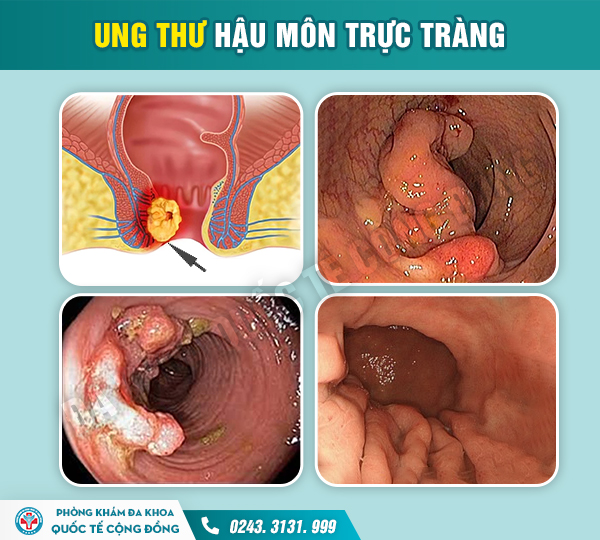 Chảy Máu Hậu Môn – Nguyên Nhân Và Cách Chữa Hiệu Quả