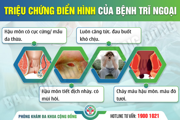 Khám phá bệnh trĩ ngoại và cách điều trị hiệu quả nhất