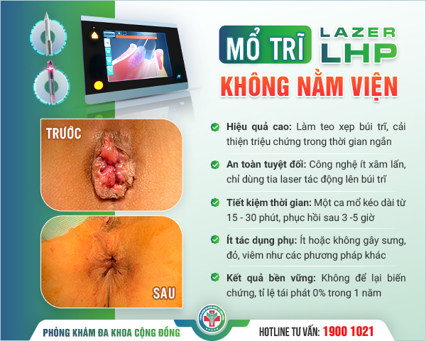 Cắt trĩ Laser LHP thế hệ mới – An toàn, phục hồi nhanh, hiệu quả bền vững