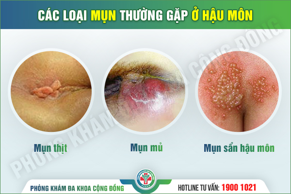 Giải mã nguyên nhân khiến hậu môn nổi mụn trong 30 giây