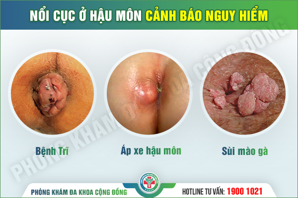 Nổi cục ở hậu môn: Hiểu sai - Ngại khám và cái giá là biến chứng nguy hiểm