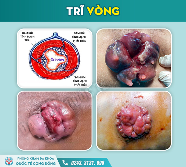 Chữa trĩ vòng hiệu quả với BS. Trưởng khoa Ngoại tiêu hóa BV Xanh Pôn